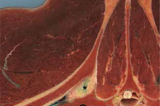 Figure 1. Photograph (cranial-caudal) of a transverse sacropelvic anatomic section showing the right sacroiliac joint. Ultrasound-guided sacroiliac joint region injection was performed with methylene blue before dissection. Note the interosseous sacroiliac ligament (*) with some methylene blue staining, the ventral sacroiliac ligament (arrowhead) and the sacroiliac joint where the hyaline cartilage of the sacrum is stained with methylene blue. I=ilium; S=sacrum.