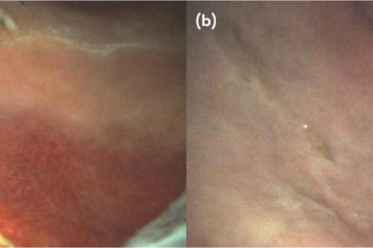 Figure 3. Case 5. 6-year-old, Welsh Pony, mare. Before (a) and after (b) treatment with esomeprazole for 14 days.