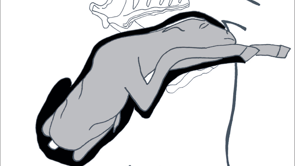 Figure 1. Elbow-lock posture.