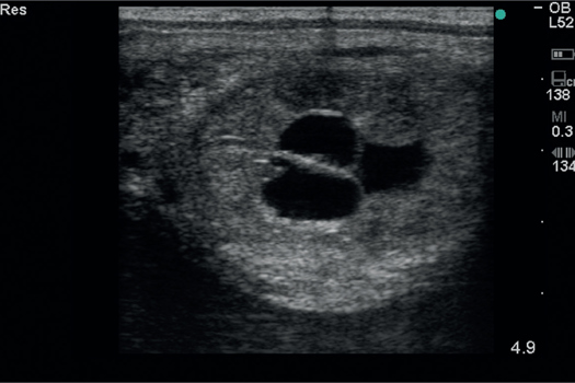 Figure 6. Transrectal ultrasound examination demonstrating three cysts in ‘complex’ in the uterine horn (ultrasound depth 4.9 cm).