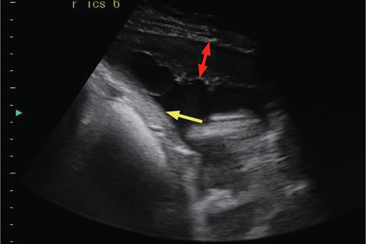 Figure 6. Layers of fibrin on the parietal pleural surface (red arrow) and along the diaphragm (yellow arrow) in a horse with pleuropneumonia. There is a small volume of pleural fluid. Dorsal is to the right in this image.
