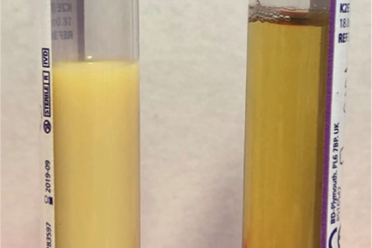 Figure 1. Lipaemic plasma from a mixed breed pony with enterocolitis (left). Note the difference with plasma from a healthy horse (right).