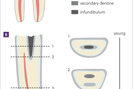 Figure 1. Schematic to show the structural differences between brachydont and hypsodont teeth. a) Brachydont tooth (molar) has a low crown covered with enamel, and cementum is only present below the gumline. b) Hypsodont tooth (incisor) has a long reserve crown and continually erupt with the appearance of the occlusal surface changing as the animal ages.