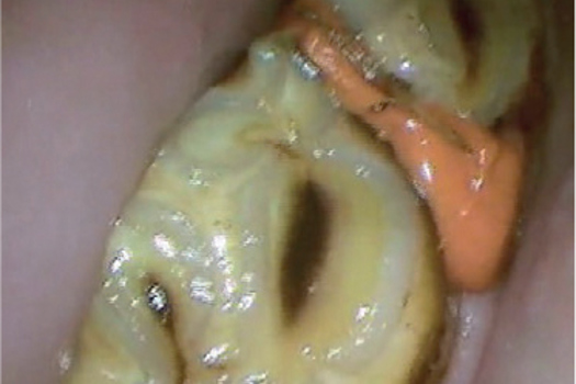 Figure 6. Vinyl polysiloxane in a 310/311 diastema.