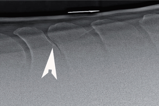 Figure 1. Latero-lateral radiograph of the dorsal spinous processes (DSP) of the thoracic vertebrae T9–T16. In this radiograph, the DSP are touching at one site (arrowhead) leading to sclerosis and remodelling.
