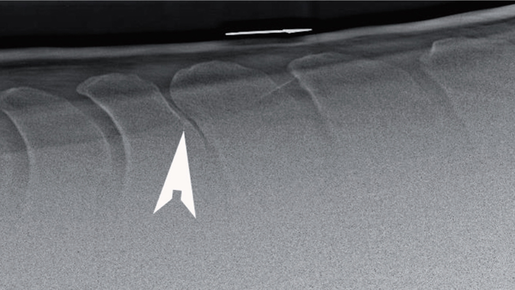 Figure 1. Latero-lateral radiograph of the dorsal spinous processes (DSP) of the thoracic vertebrae T9–T16. In this radiograph, the DSP are touching at one site (arrowhead) leading to sclerosis and remodelling.