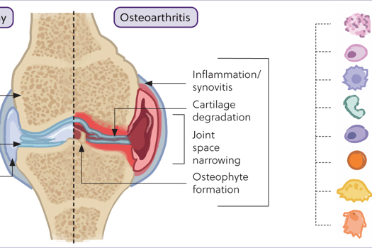 Figure 1. Diagram of the equine metacarpophalangeal joint demonstrating molecular and structural changes found within a healthy joint compared to an osteoarthritic joint.