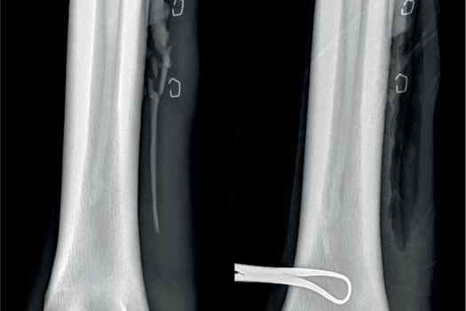 Figure 7. This is the same horse as Figure 5. Radiograph (dorsolateral-palmaromedial oblique) of a comminuted displaced fourth metatarsal fracture (A). The fracture plane and distal fragment were surgically resected (B).
